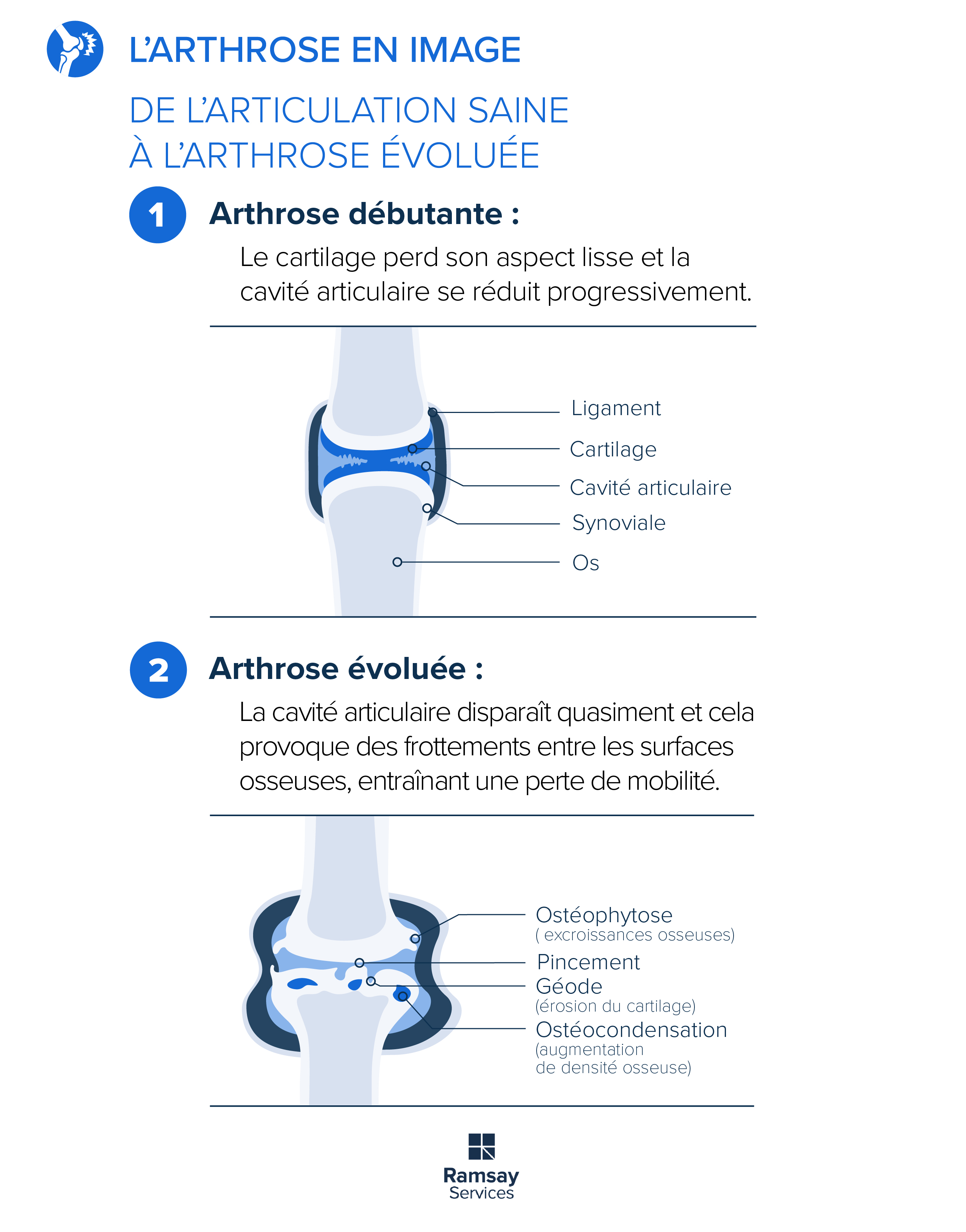 L'arthrose en image