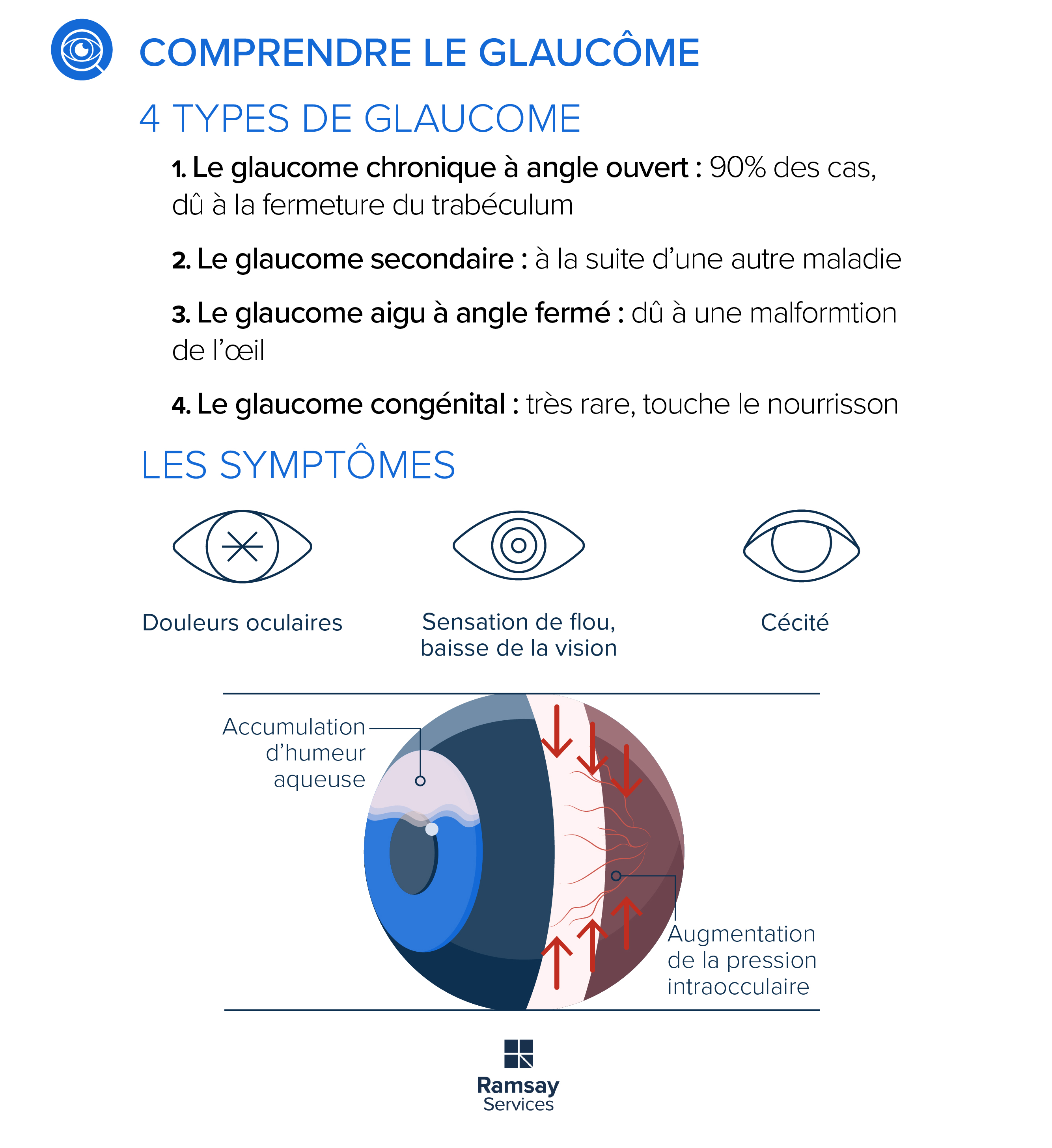 Comprendre le glaucôme