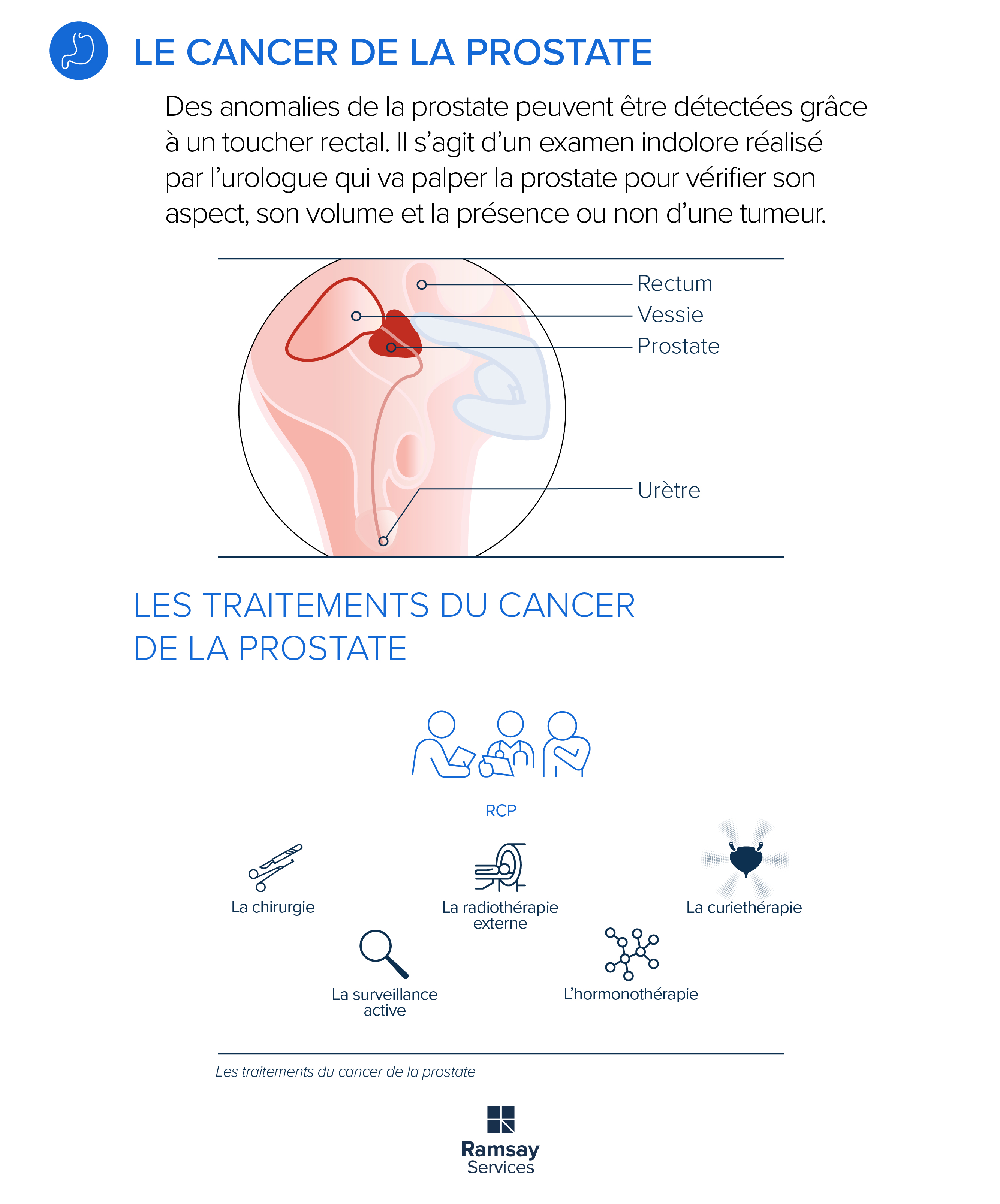 Le cancer de la prostate