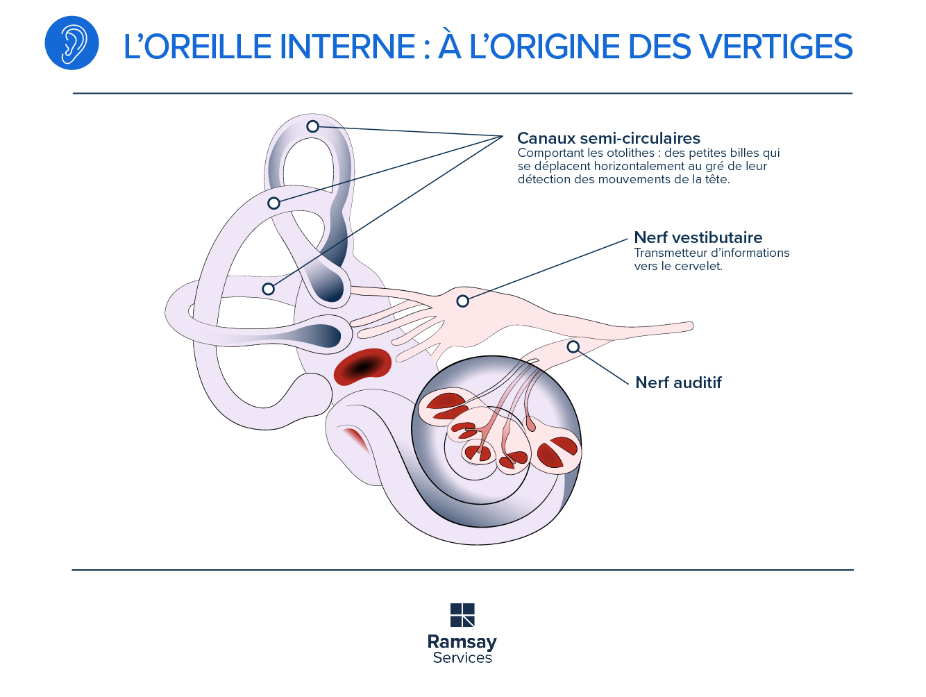 Cristaux de l'oreille interne : quand entraînent-ils des vertiges ?