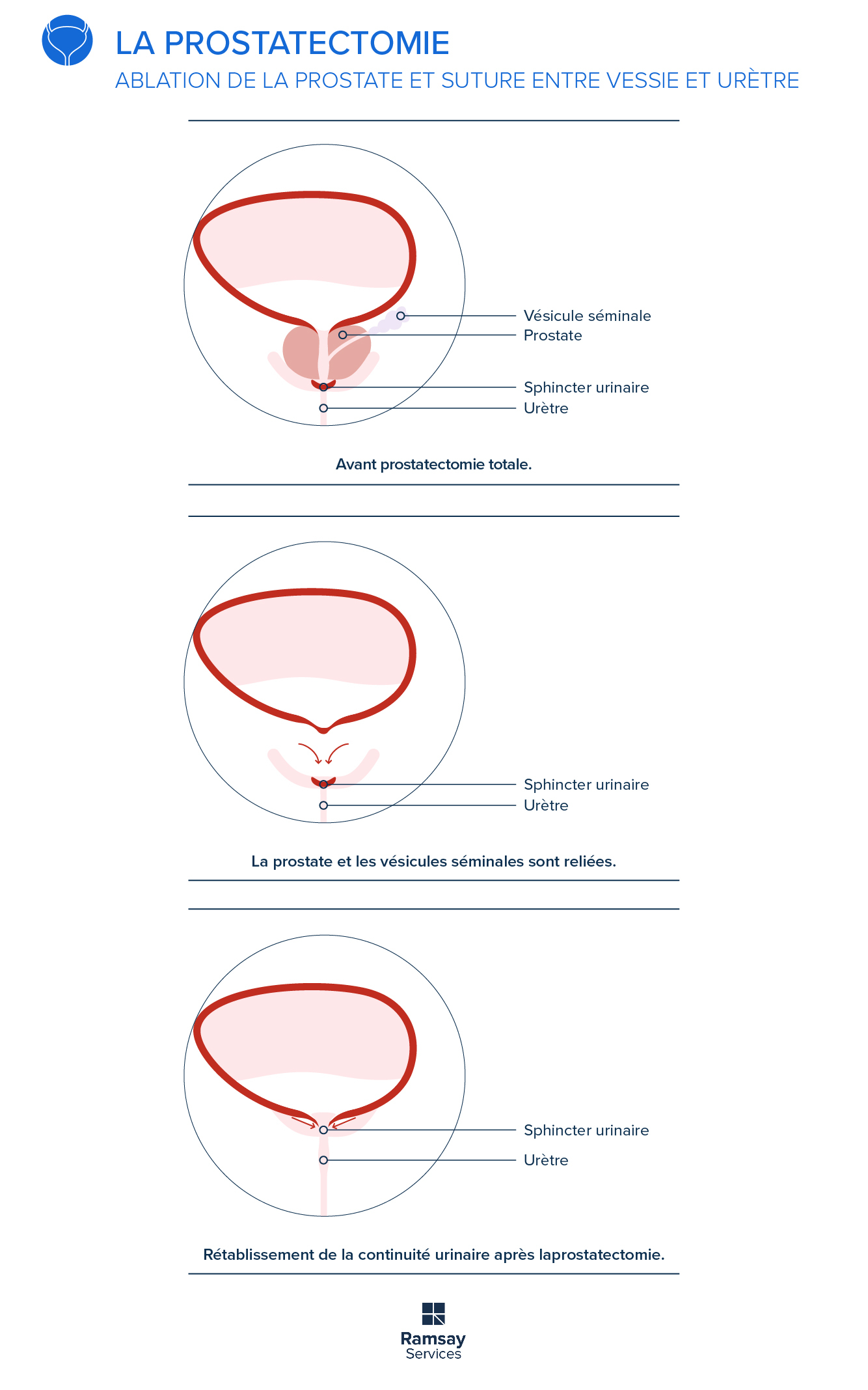 Prostatectomie : tout savoir sur ce traitement du cancer de la prostate