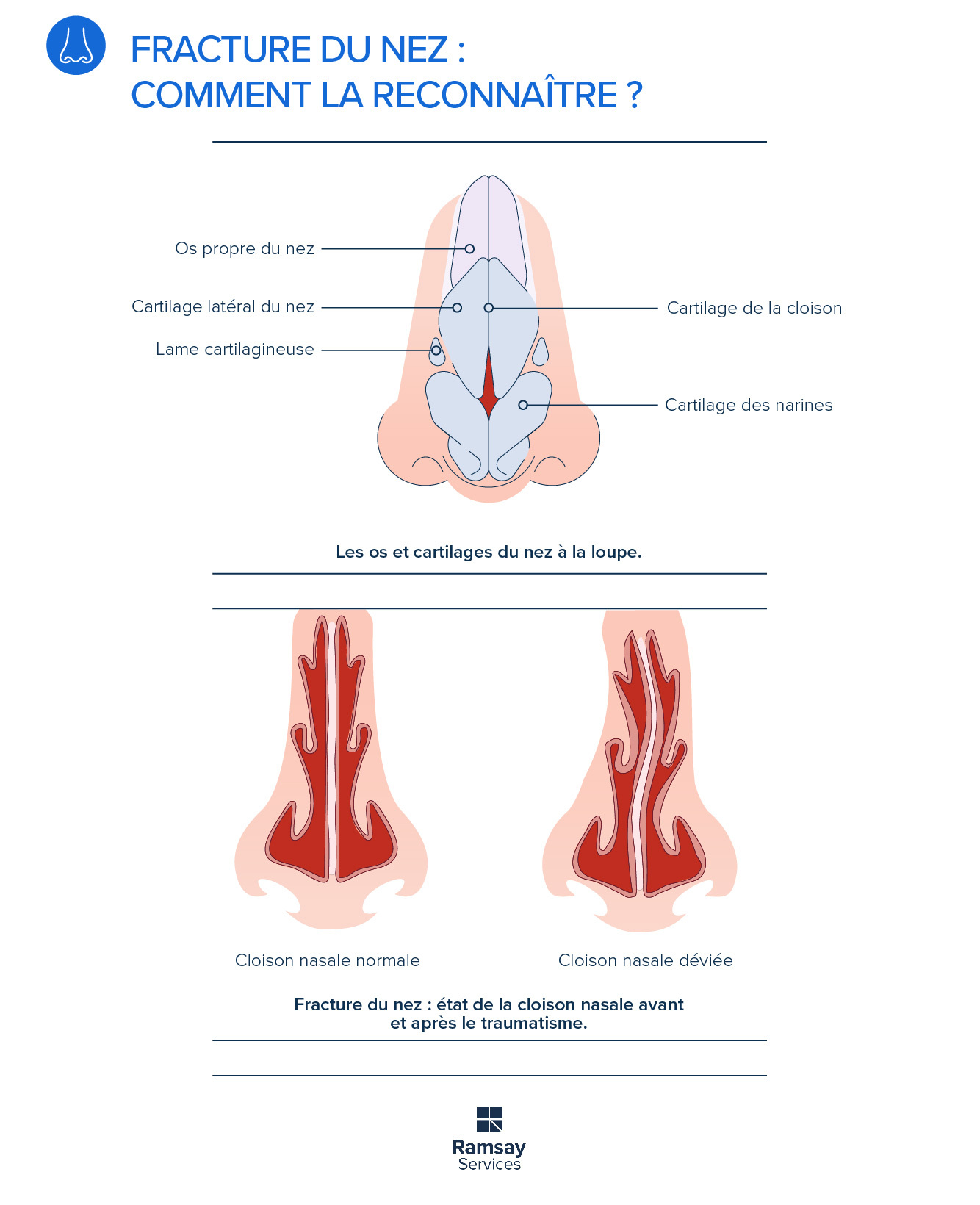 Fracture du nez : comment la reconnaître et réagir ?