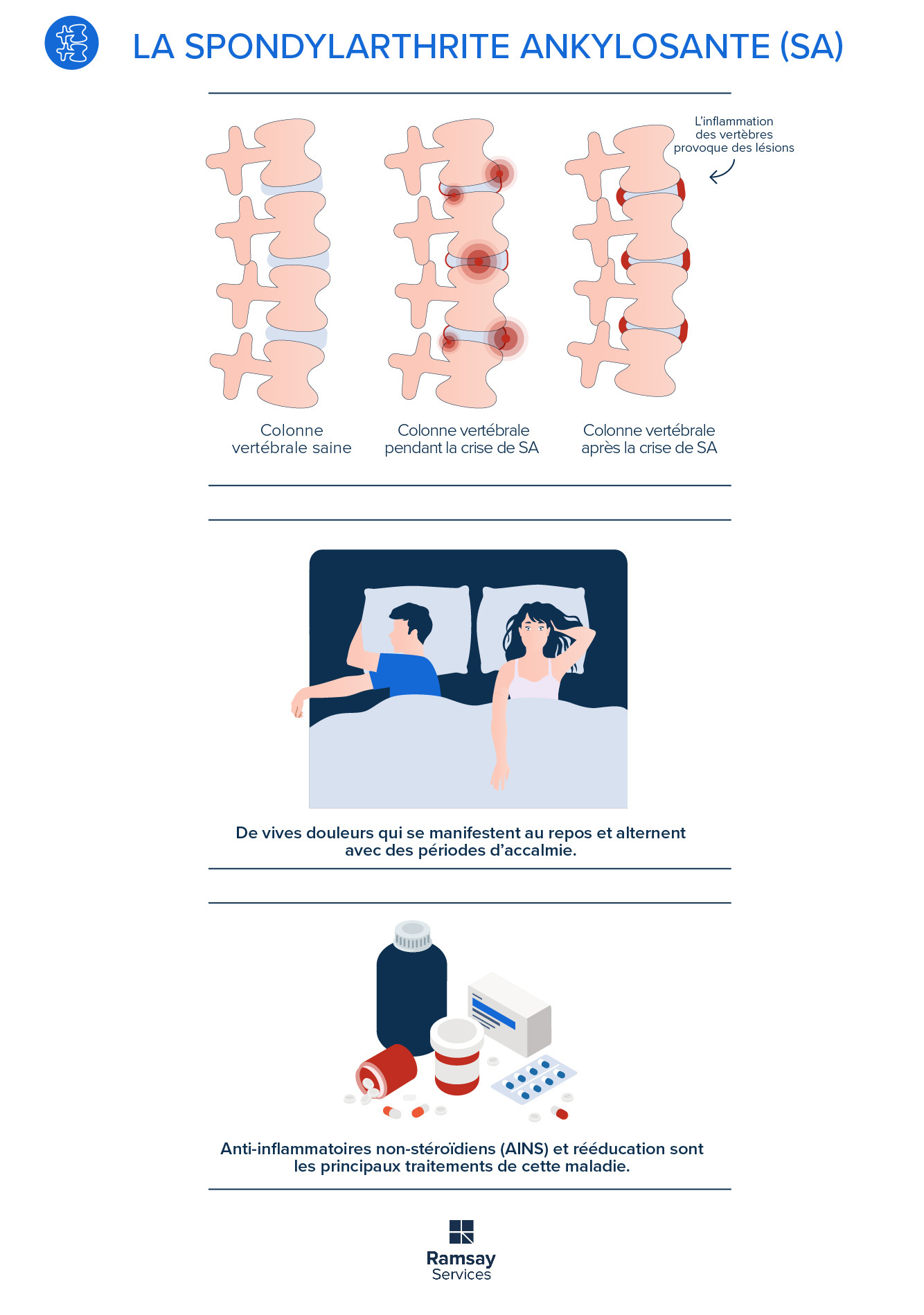 Spondylarthrite ankylosante : quand la douleur laisse des traces