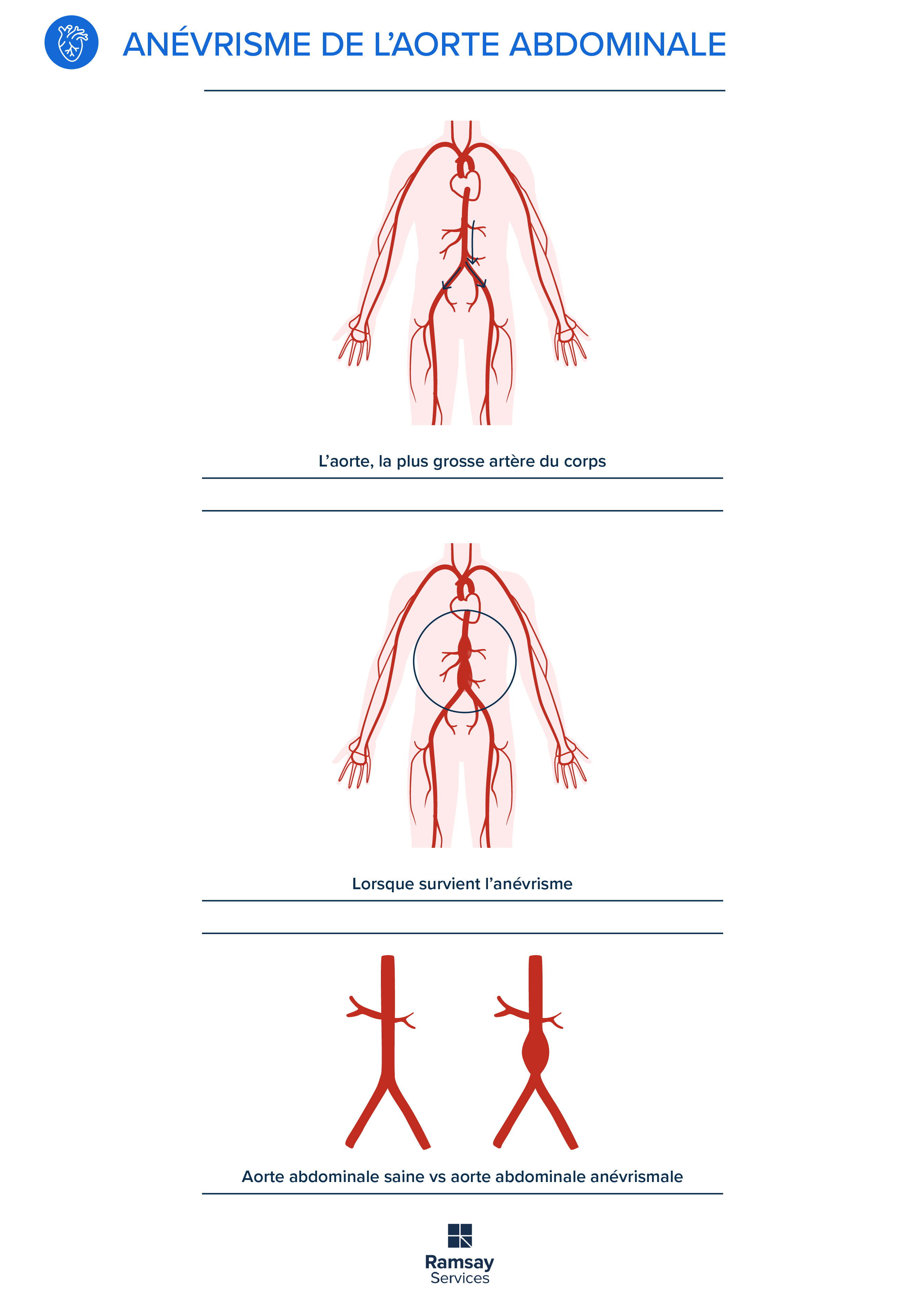 Anévrisme de l’aorte abdominale : focus sur la chirurgie vasculaire ou endovasculaire