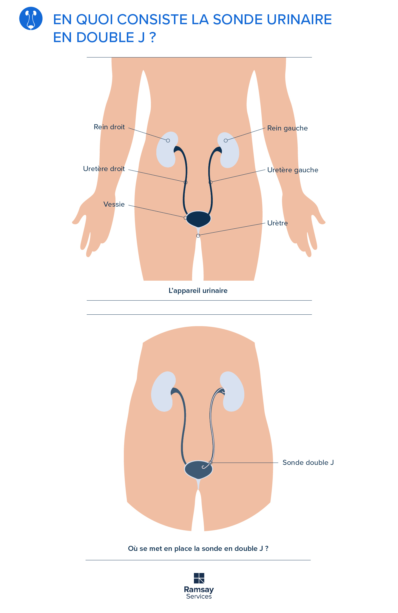 Urologie : en quoi consiste la sonde urinaire en double J ?