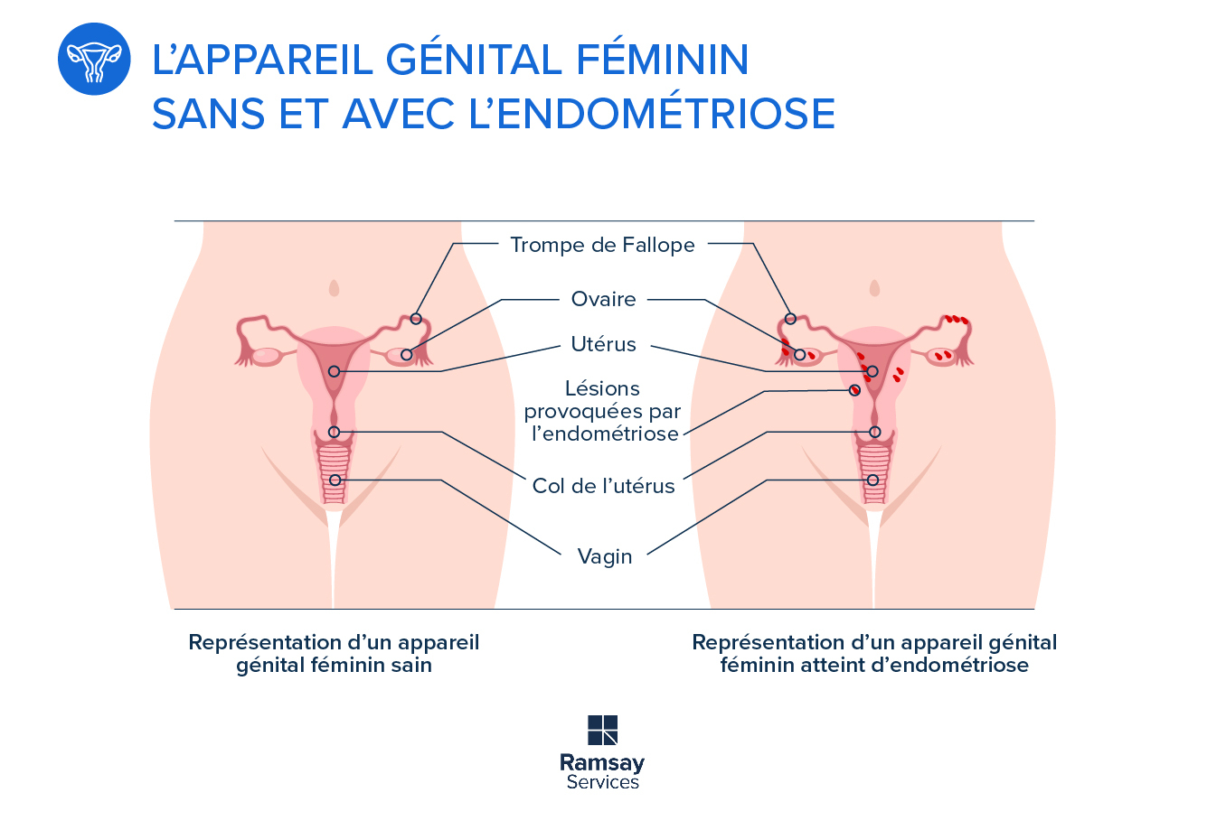 Endométriose : une maladie complexe mais fréquente