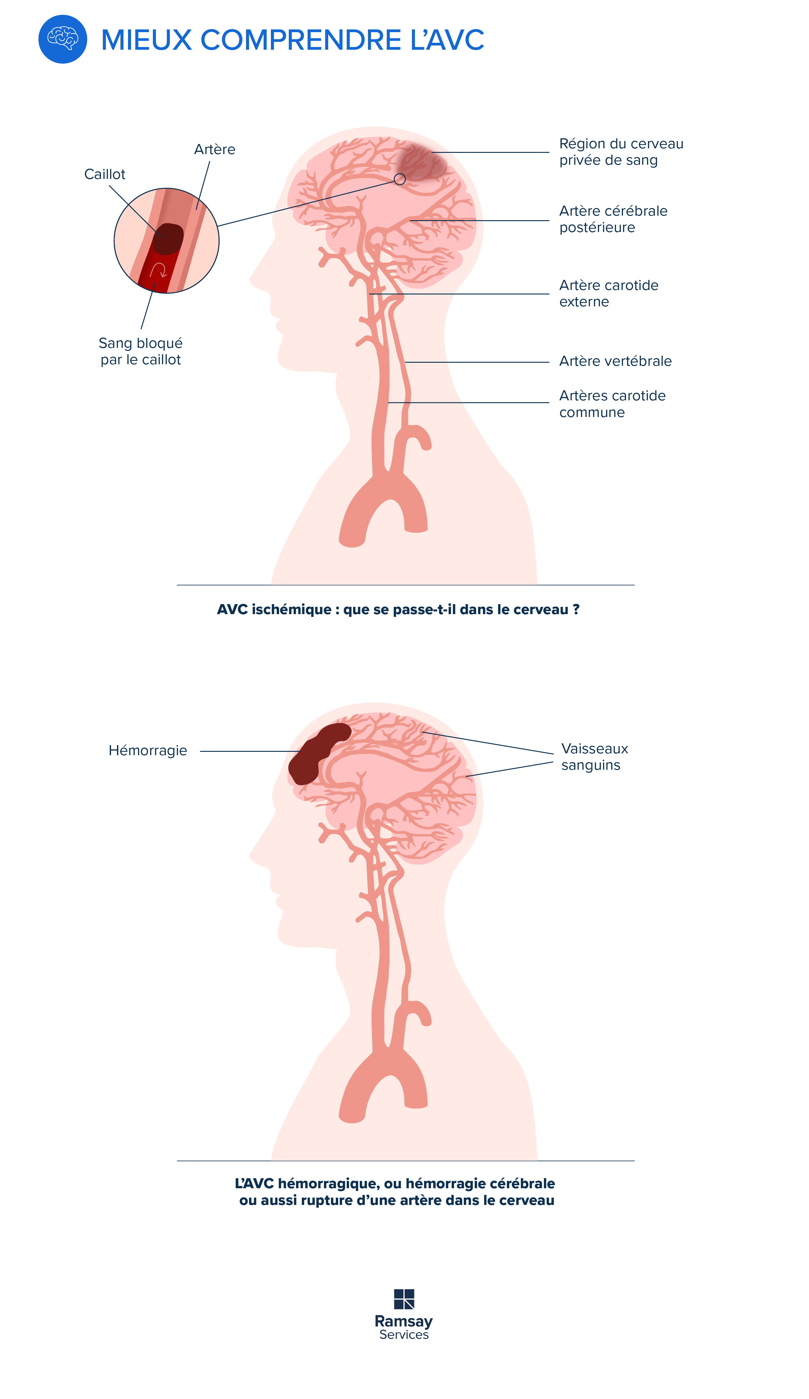 Mieux comprendre l'AVC 