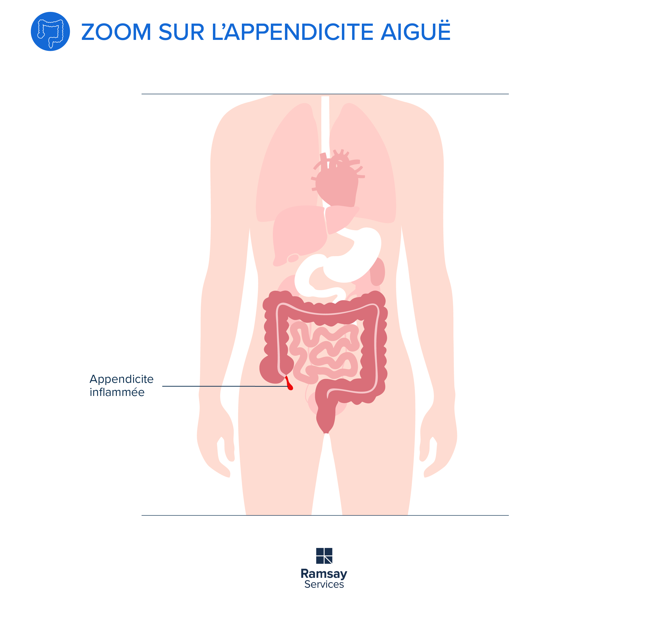 L'appendicite aiguë : bénigne mais à soigner en urgence !