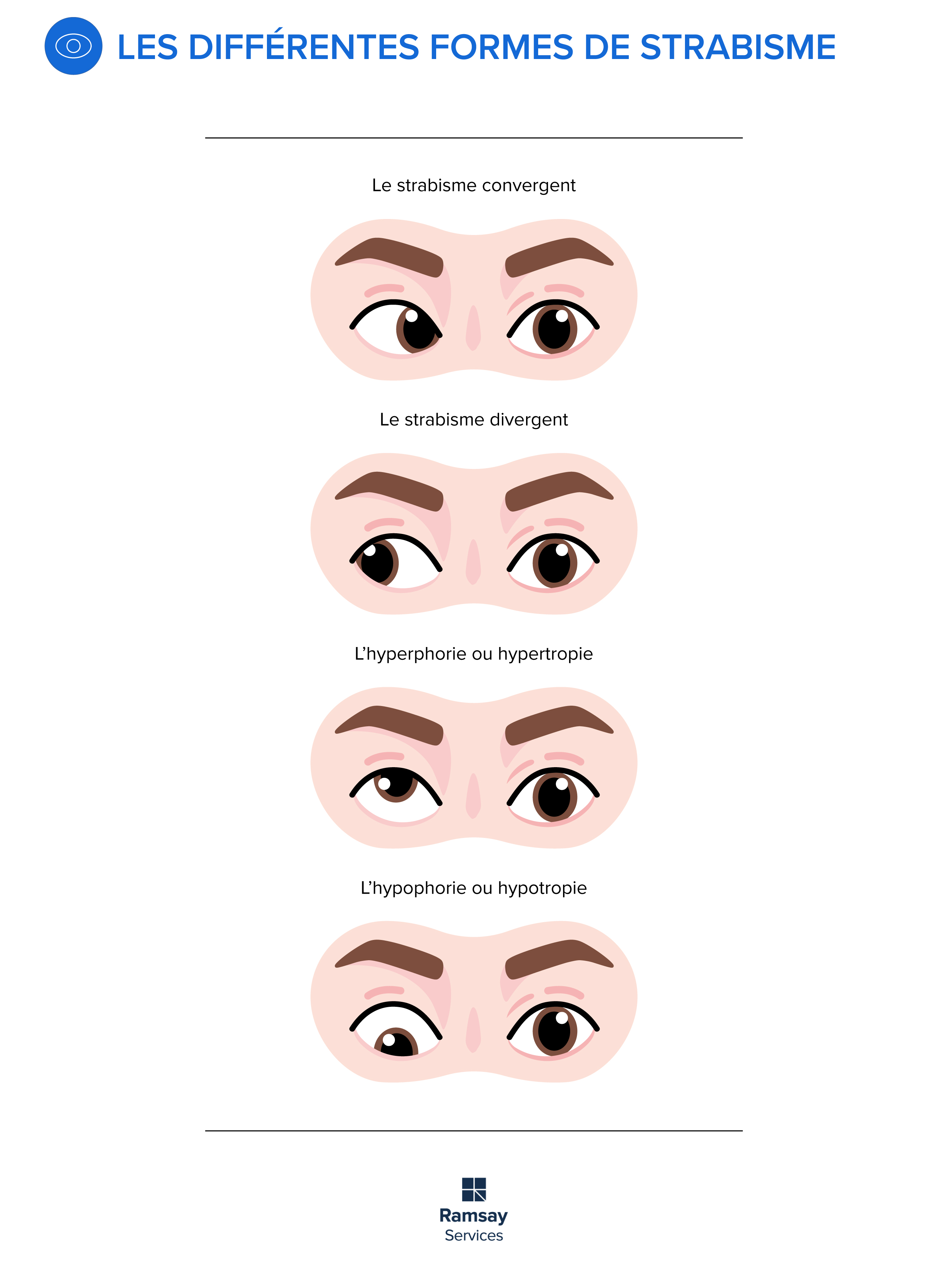 Les différentes formes de strabismes