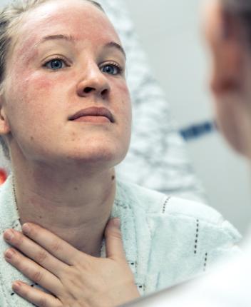 Eczema