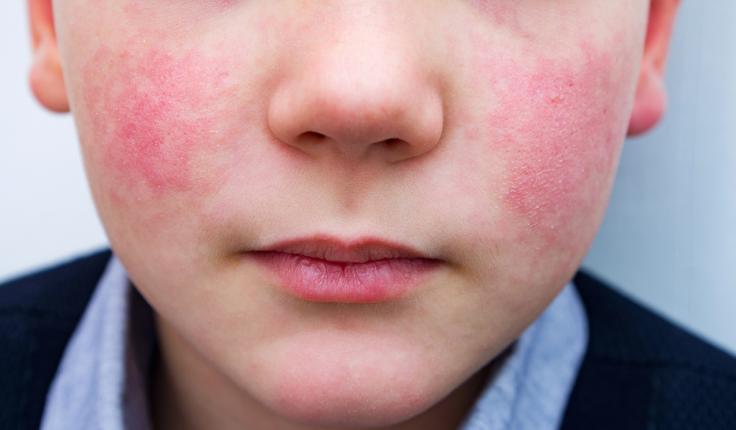 lupus