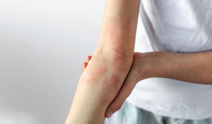 Eczéma