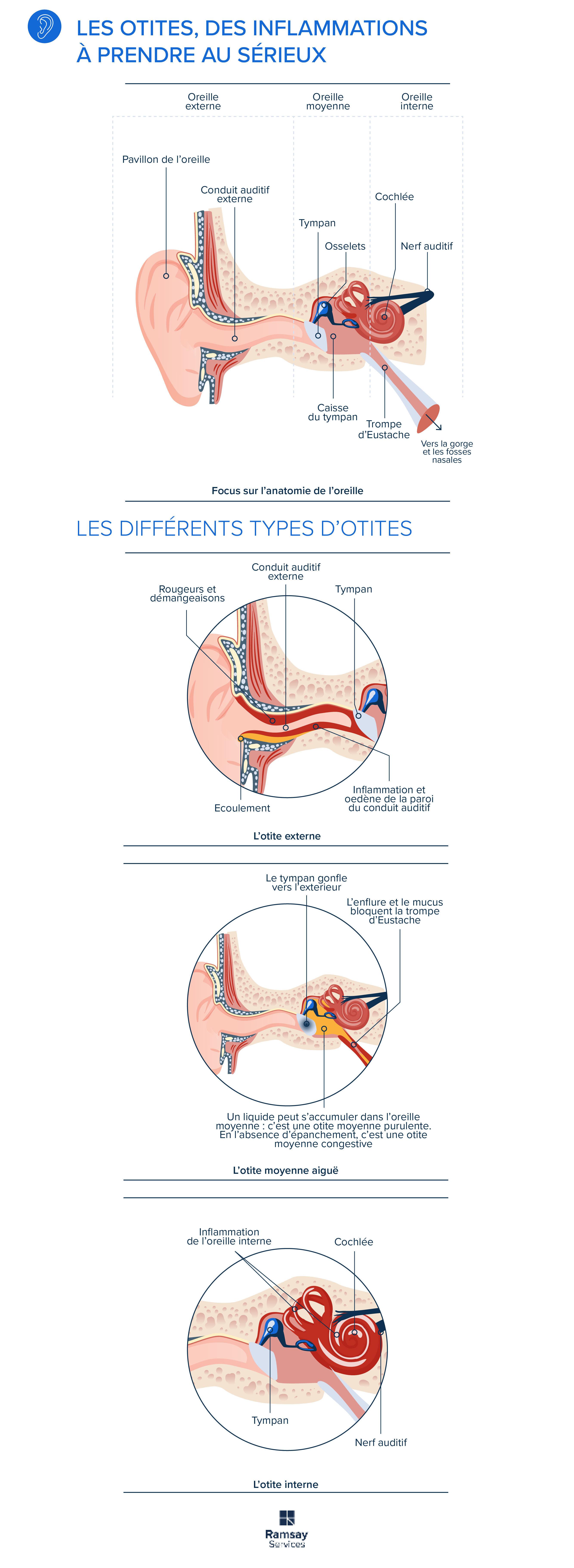 Sensation d'oreille bouchée : à quoi est-ce dû ?