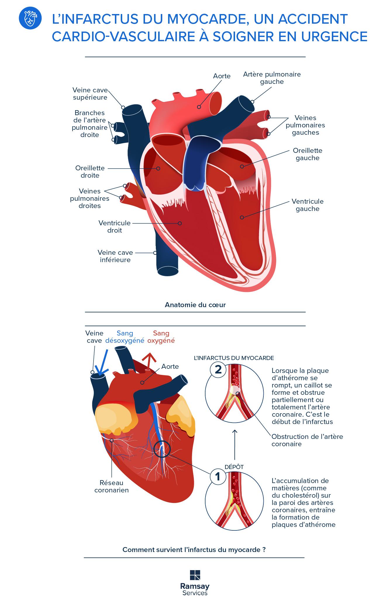 Infographie Infarctus