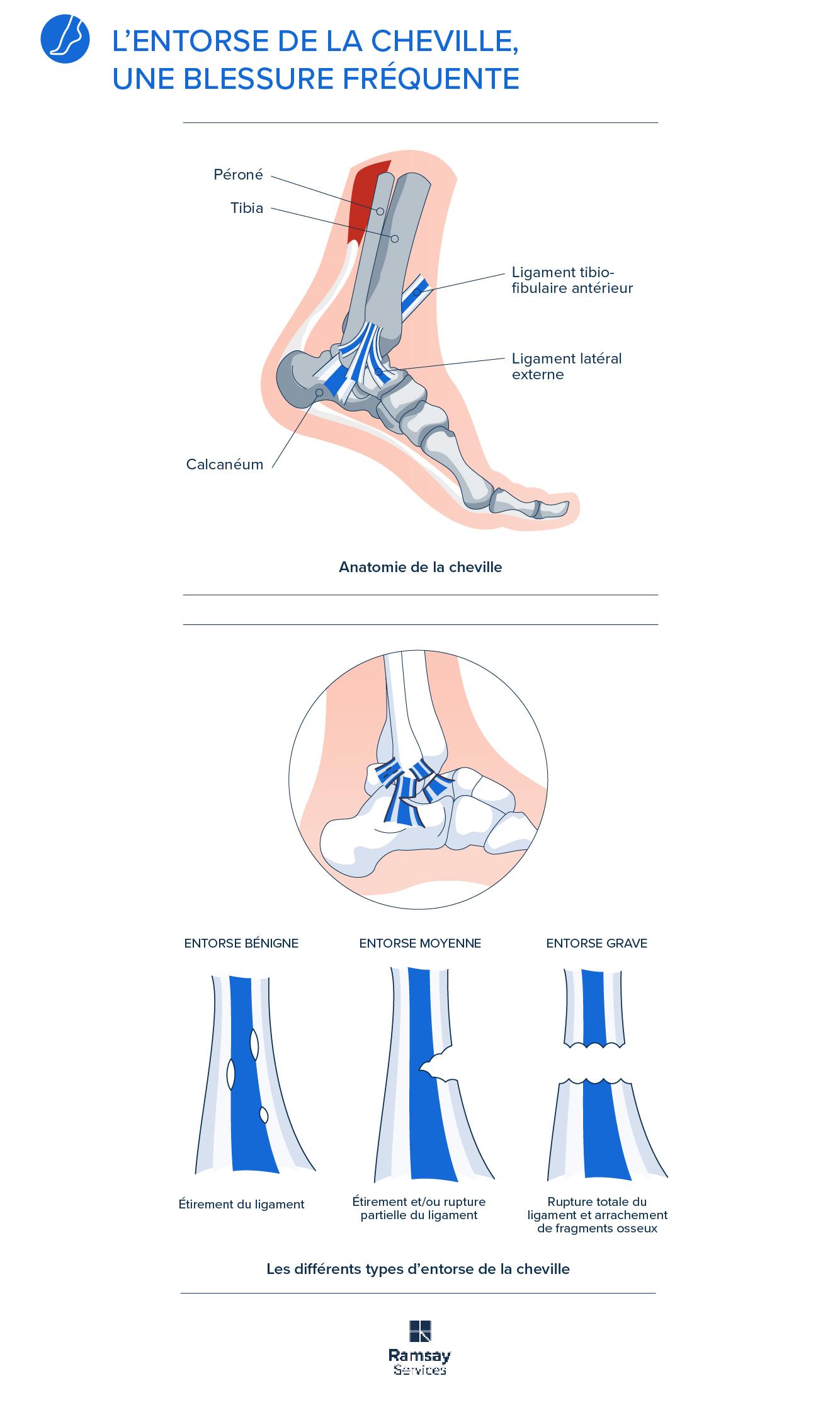 Tout savoir sur l'entorse, une blessure qui touche surtout la cheville