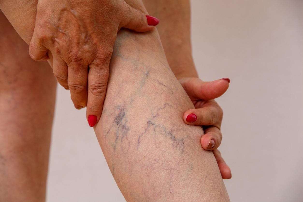 Supprimer les varices : tout savoir sur les deux techniques ...