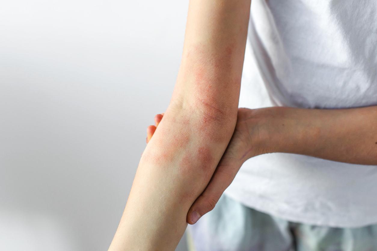 Eczéma
